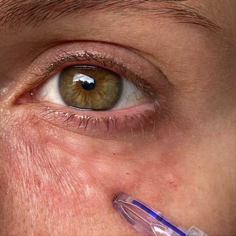MESOTERAPIA OJERAS PARA HIPERPIGMENTACION