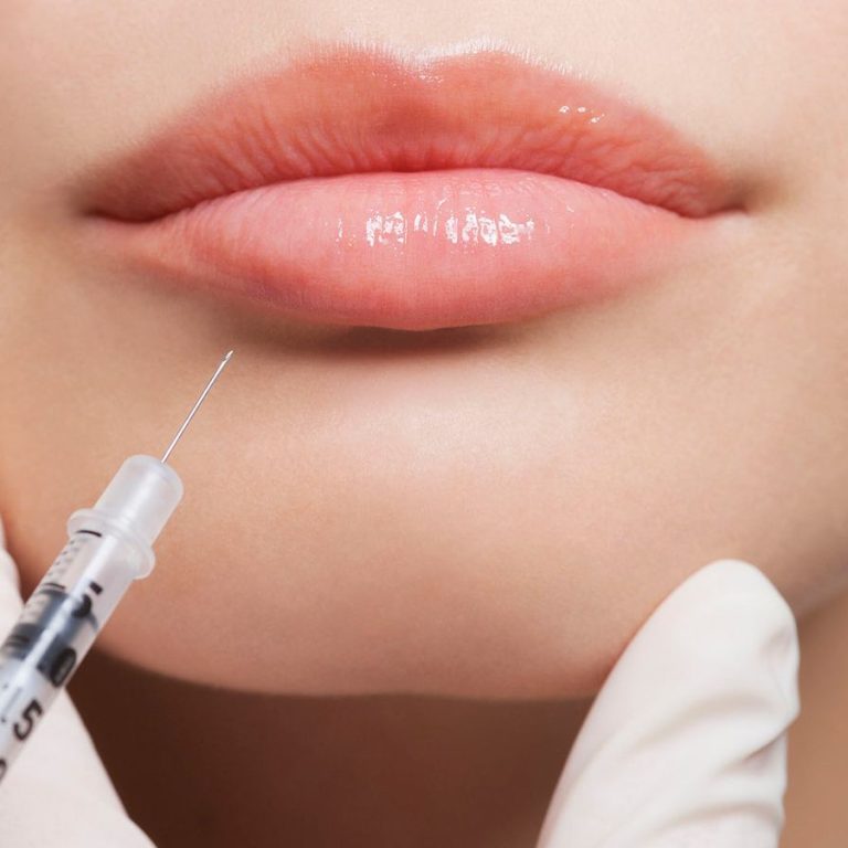 Rellenos de labios con ácido hialurónico